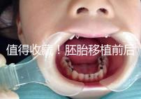 值得收藏！胚胎移植前后這些注意事項(xiàng)都應(yīng)該知道