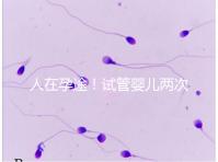 人在孕途!試管嬰兒兩次胎停育,了解這幾招能降低流產風險