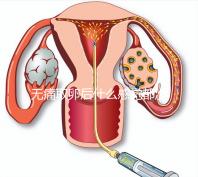 無痛取卵后什么感覺都沒有異常是謠言!只會出現(xiàn)一部分...