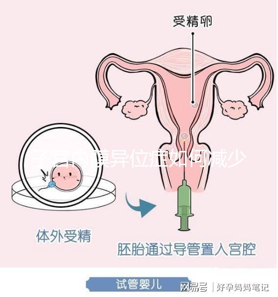 子宮內膜異位癥如何減少手術次數，增加試管嬰兒成功率？