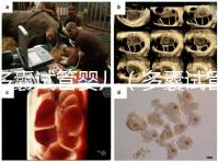 多囊試管嬰兒(多囊試管嬰兒成功率高嗎)