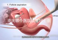 重慶哪個醫(yī)院試管好(重慶哪個醫(yī)院試管好一點)