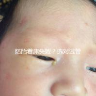 胚胎著床失?。窟x對試管嬰兒醫生很重要