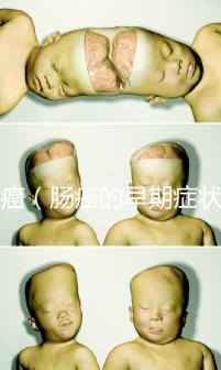 腸癌（腸癌的早期癥狀有哪些）