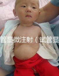 試管顯微注射(試管顯微注射什么藥)