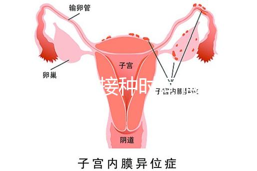 麻疹疫苗接種時間指南,初種年齡最好不要晚于這個月齡