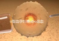 o型血孕婦患abo溶血癥幾率大，做好預(yù)防從備孕開始